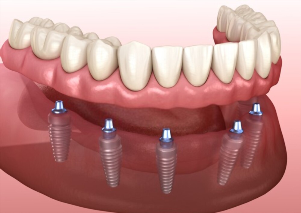 Prótese Dentária